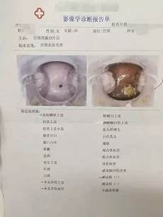 中药治痔疮今天给大家介绍的是老中医力荐的消除痔疮的方法